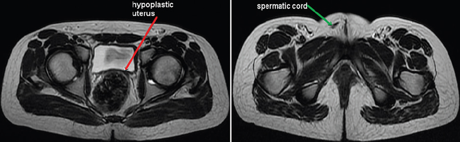 Magnetic resonance imaging showing rudimentary uterus (red arrow) and right side spermatic cord (green arrow).